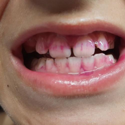 Zahngesundheitsvorsorge mit Einfärben