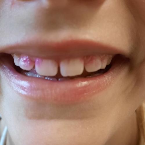 Zahngesundheitsvorsorge mit Einfärben