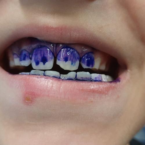 Zahngesundheitsvorsorge mit Einfärben