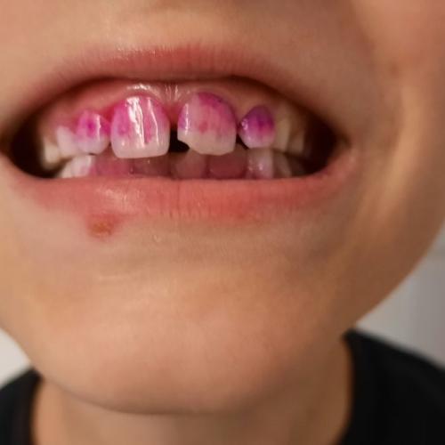 Zahngesundheitsvorsorge mit Einfärben